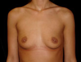 Patient # 37061 Before Photo # 1